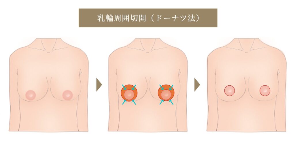 乳輪周囲切開（ドーナツ法）