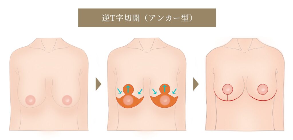 逆T字切開（アンカー型）