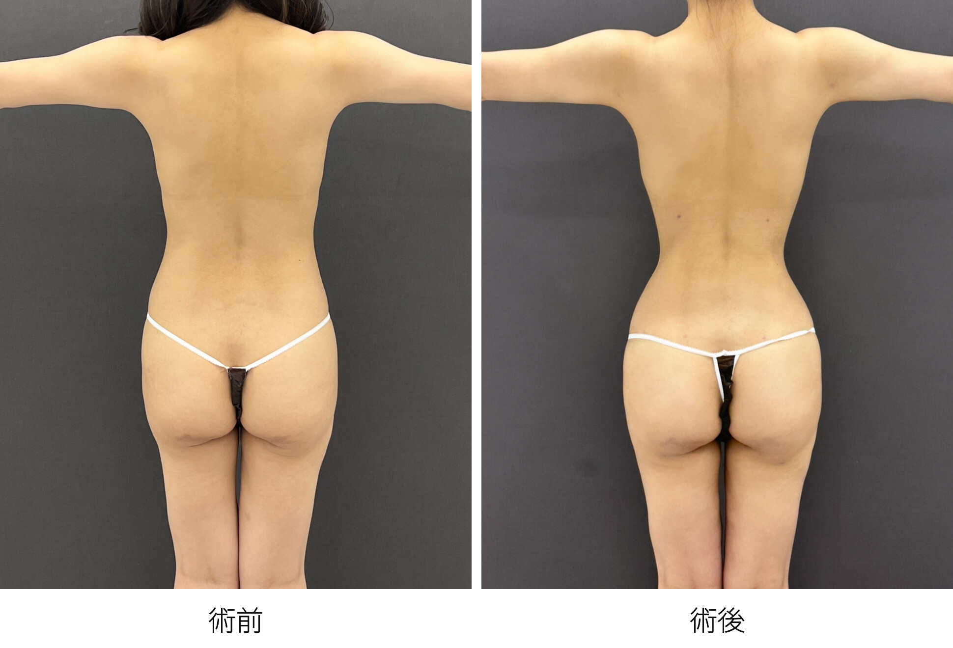 RibXcar（リブスカー/リブエクスカー） 肋骨セットバック くびれ形成 脂肪吸引