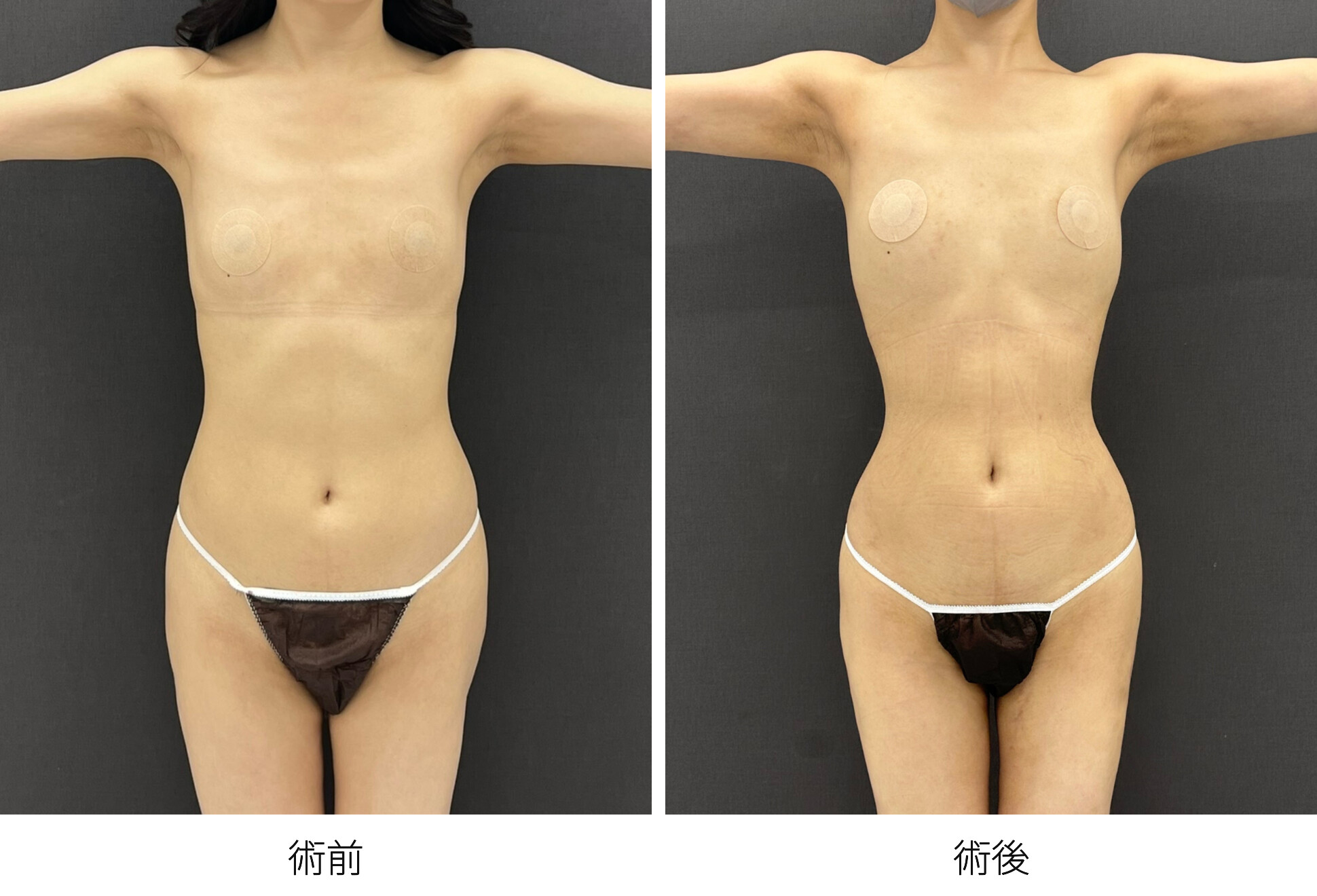 RibXcar（リブスカー/リブエクスカー） 肋骨セットバック くびれ形成 脂肪吸引