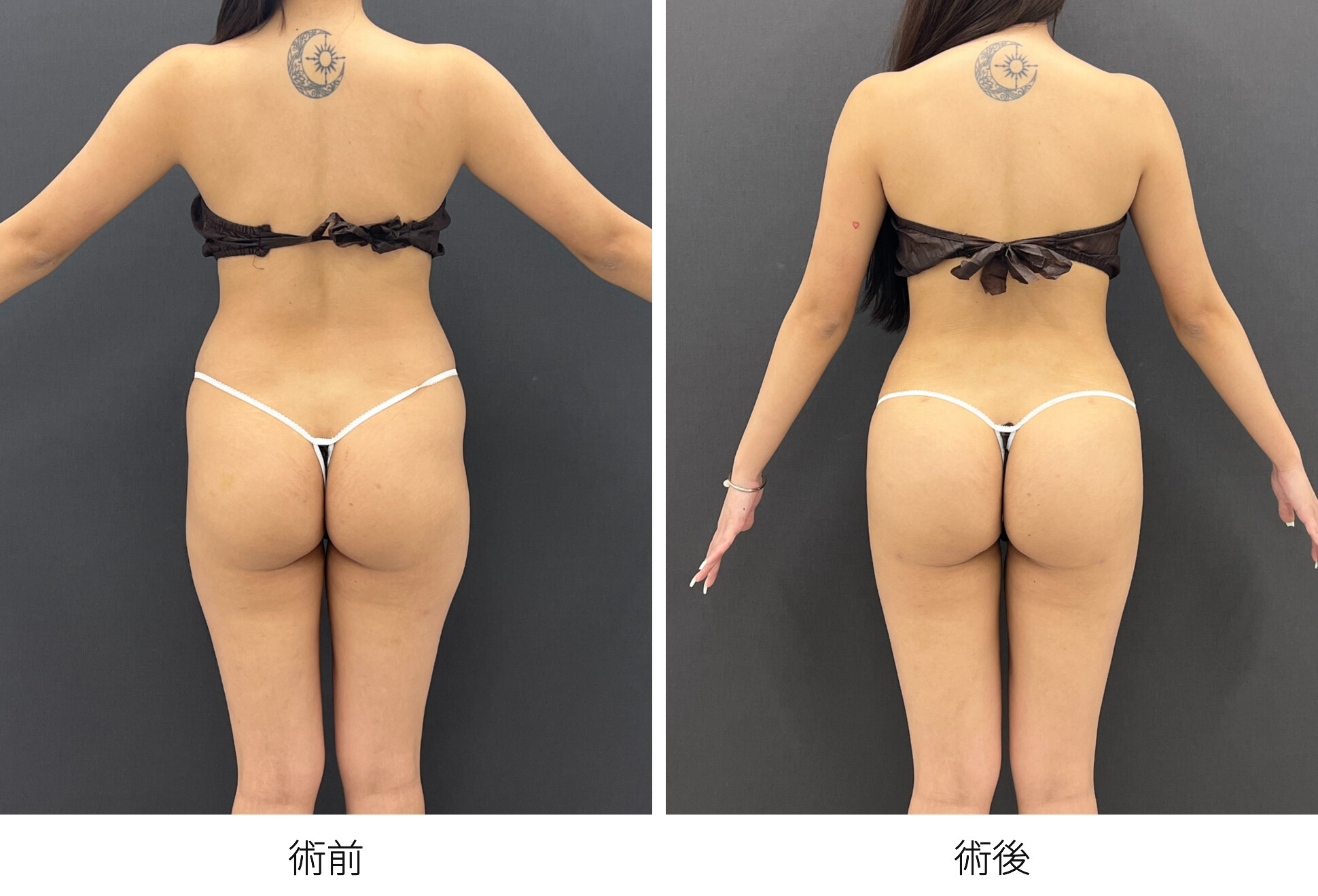 アジアンバットリフト 豊尻