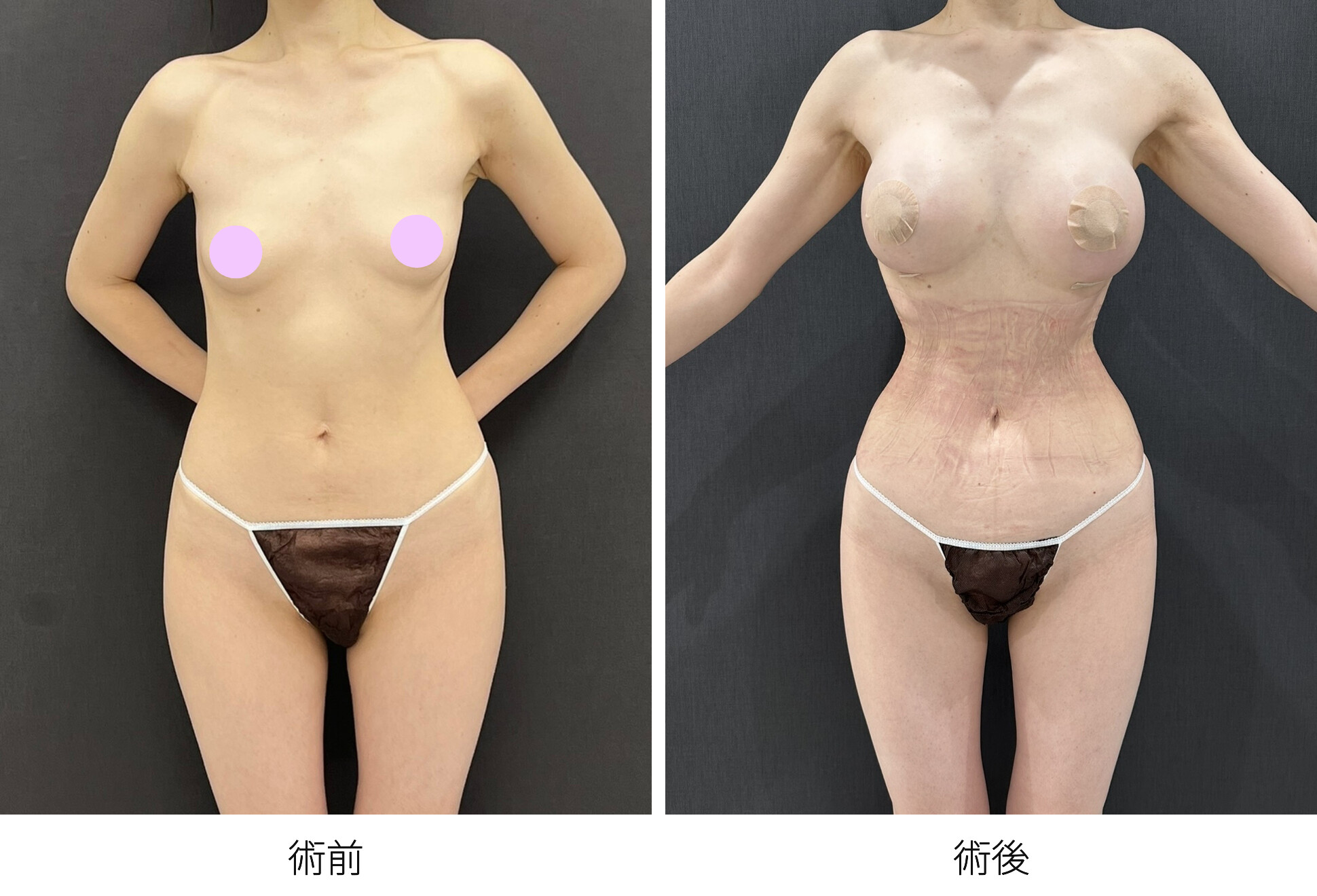 シリコンバッグ豊胸 RibXcar（リブスカー/リブエクスカー） 肋骨セットバック くびれ形成