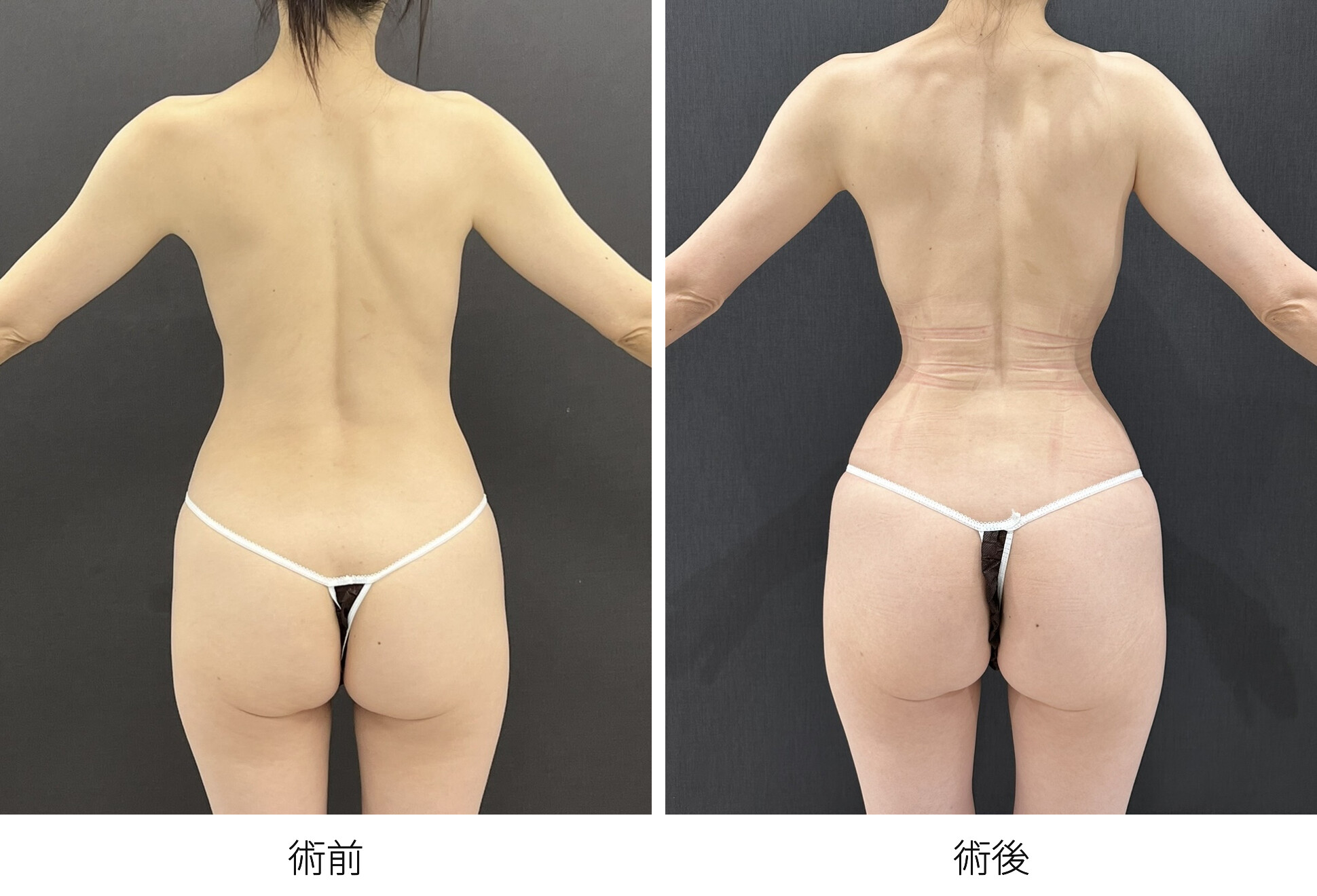 シリコンバッグ豊胸 RibXcar（リブスカー/リブエクスカー） 肋骨セットバック くびれ形成