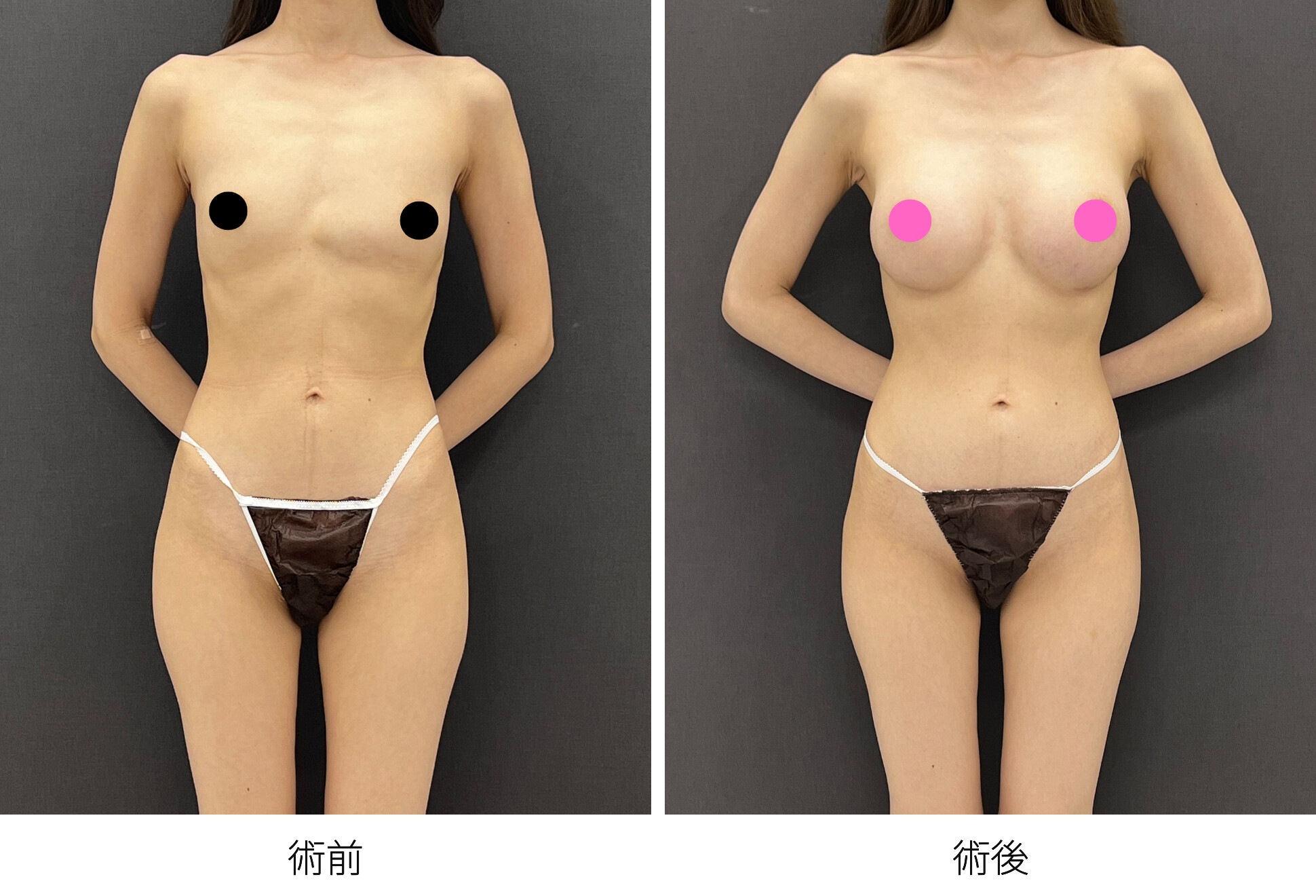 シリコンバッグ豊胸 乳腺下法 アクアフィリング除去