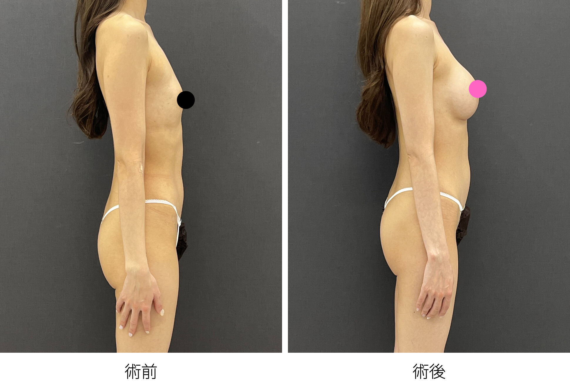 シリコンバッグ豊胸 乳腺下法 アクアフィリング除去