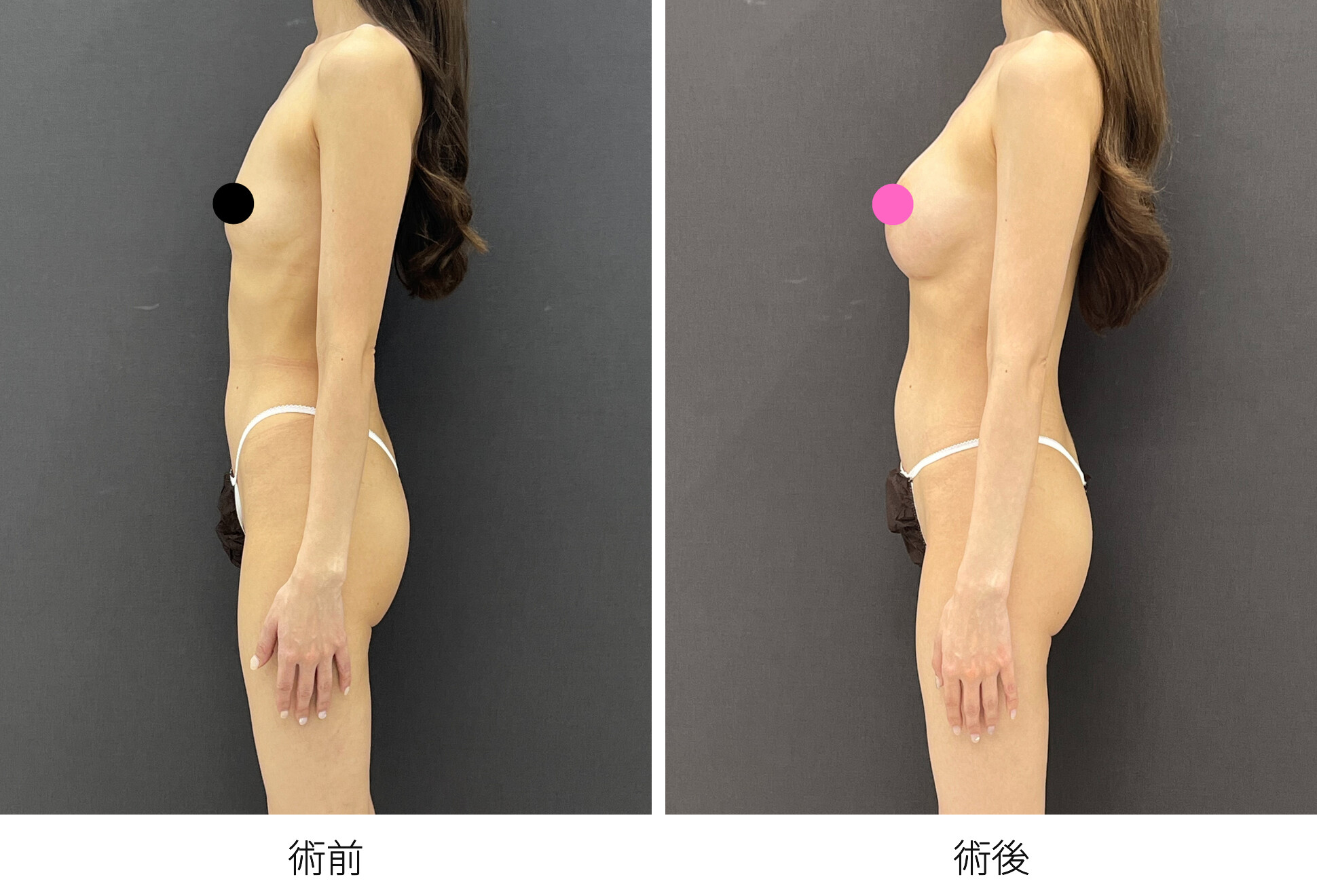 シリコンバッグ豊胸 乳腺下法 アクアフィリング除去