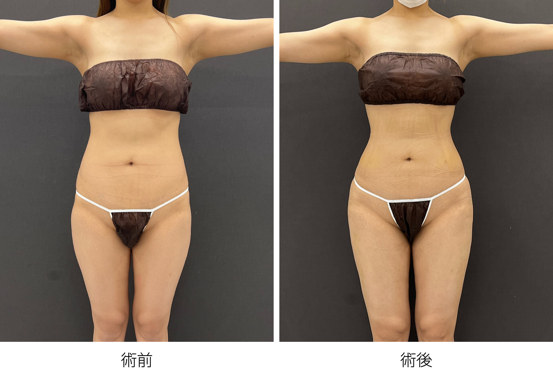 RibXcar（リブスカー/リブエクスカー） くびれ形成 肋骨セットバック