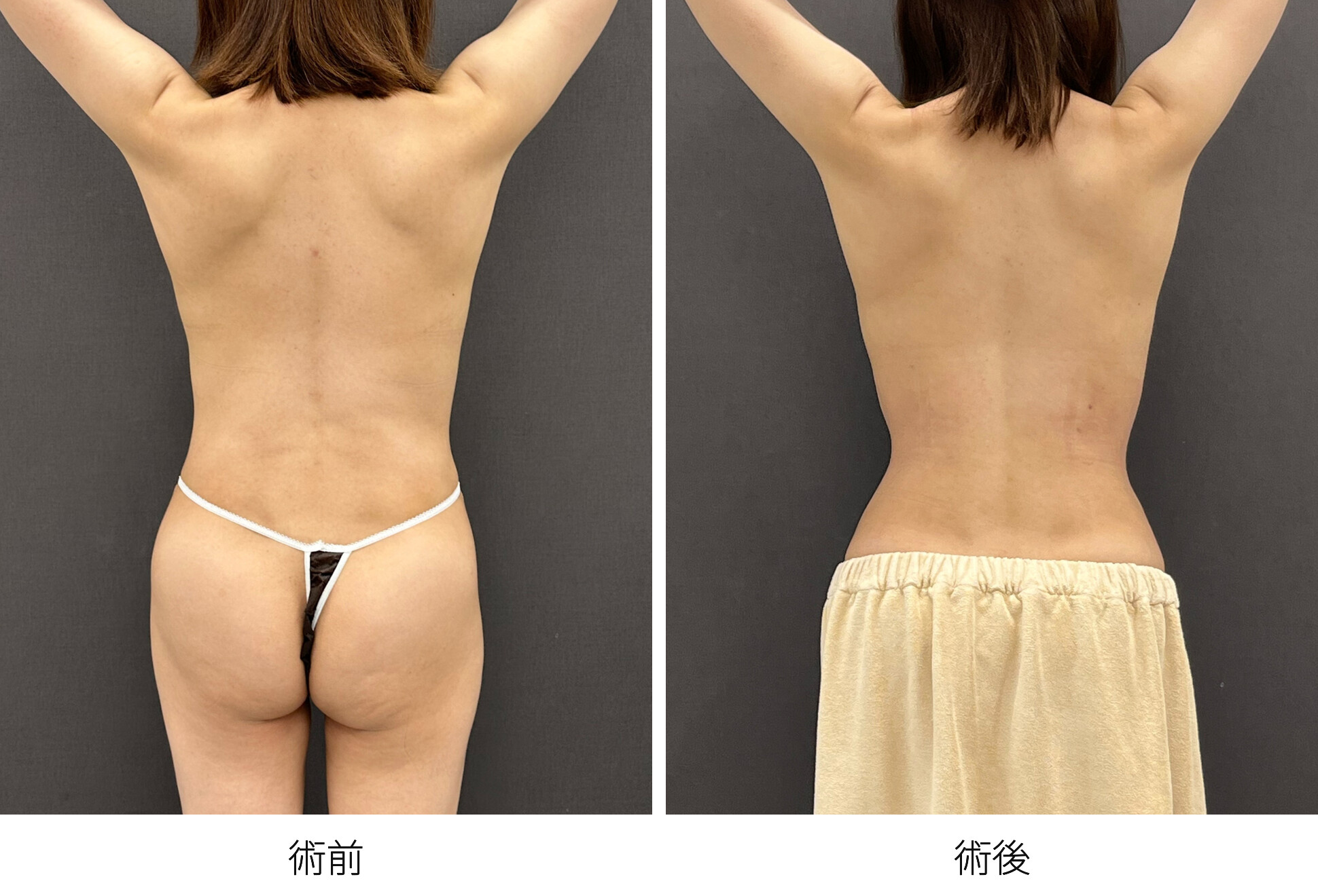 RibXcar（リブスカー/リブエクスカー） くびれ形成 肋骨セットバック