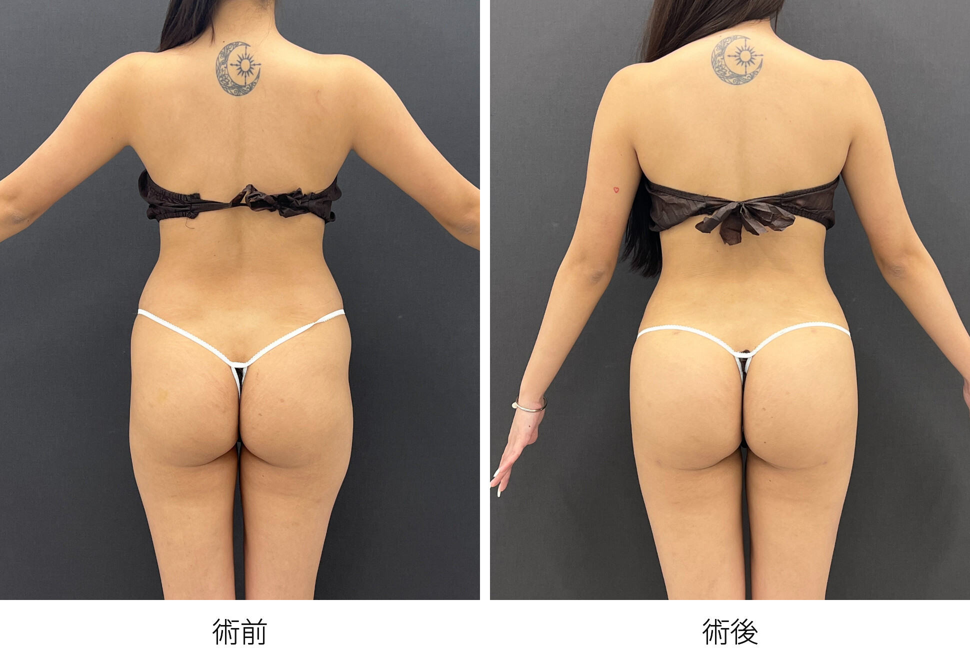 ブラジリアンバットリフト 豊尻