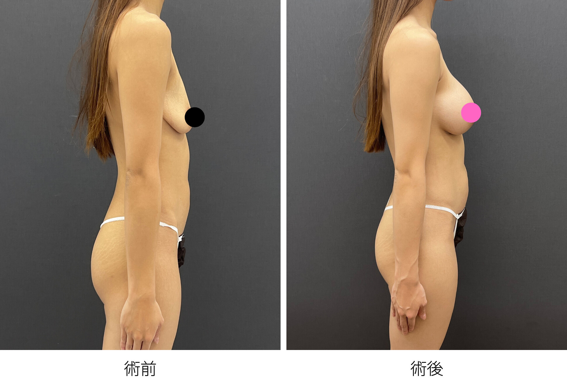 シリコンバッグ豊胸 デュアルプレーン法