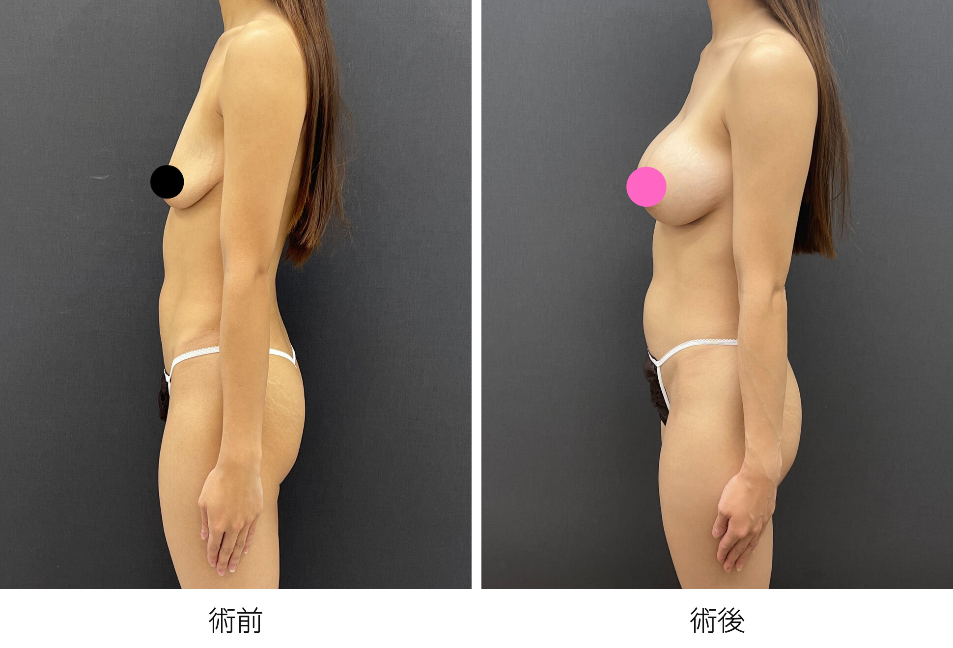 シリコンバッグ豊胸 デュアルプレーン法