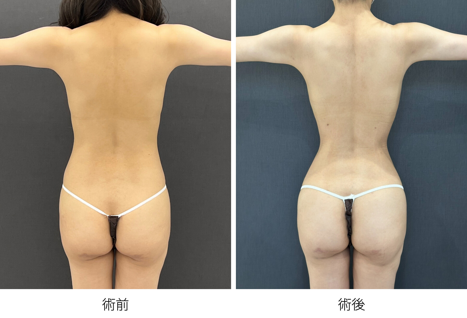 RibXcar（リブスカー/リブエクスカー） 肋骨セットバック くびれ形成