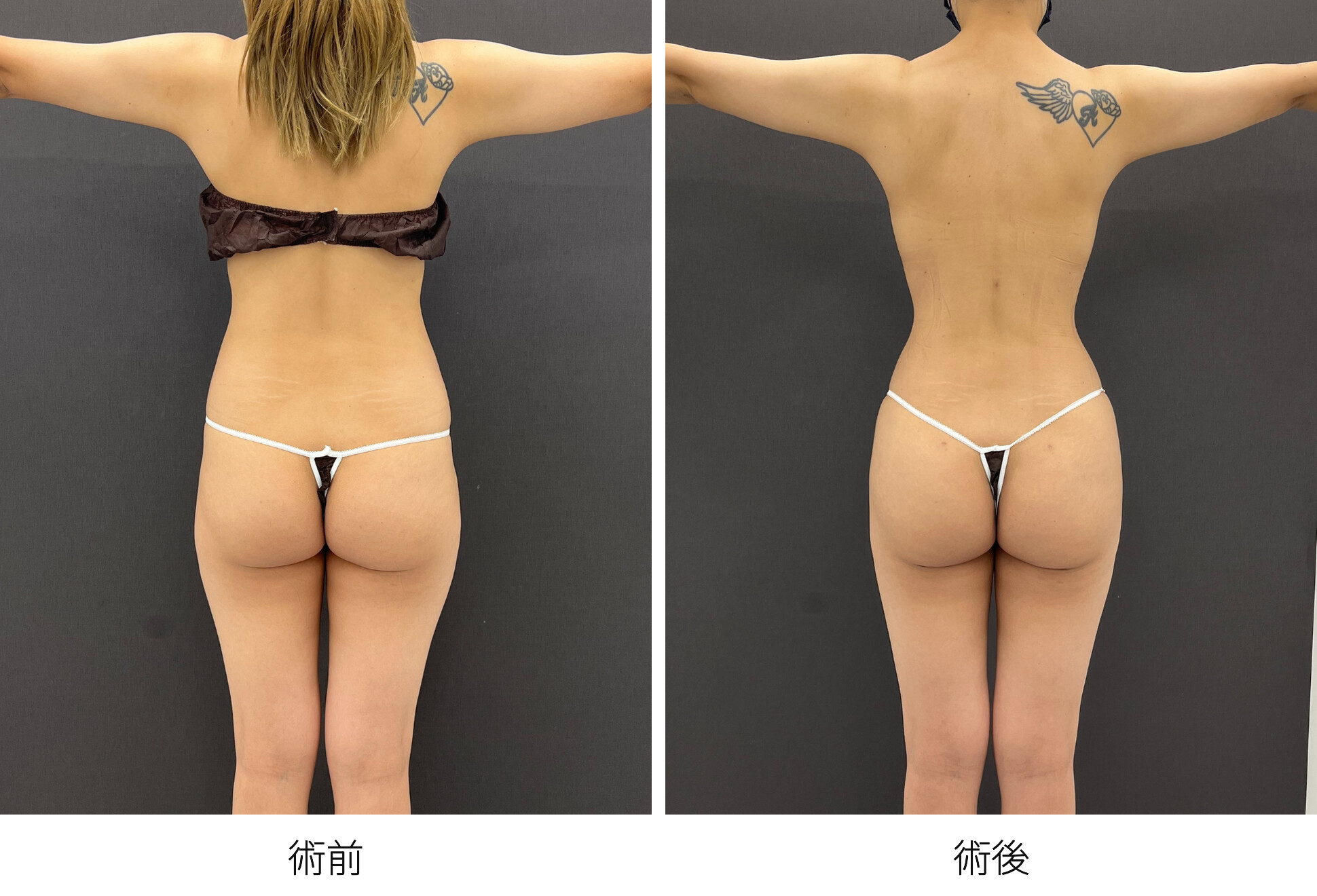 RibXcar（リブスカー/リブエクスカー） 肋骨セットバック くびれ形成 ブラジリアンバットリフト 豊尻