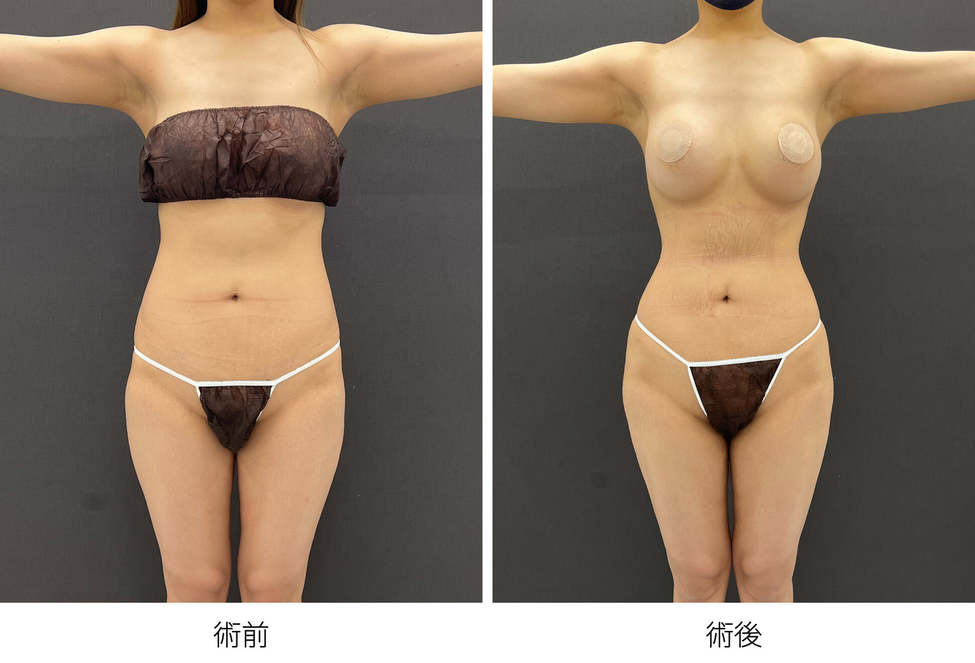 RibXcar（リブスカー/リブエクスカー） 肋骨セットバック くびれ形成 ブラジリアンバットリフト 豊尻