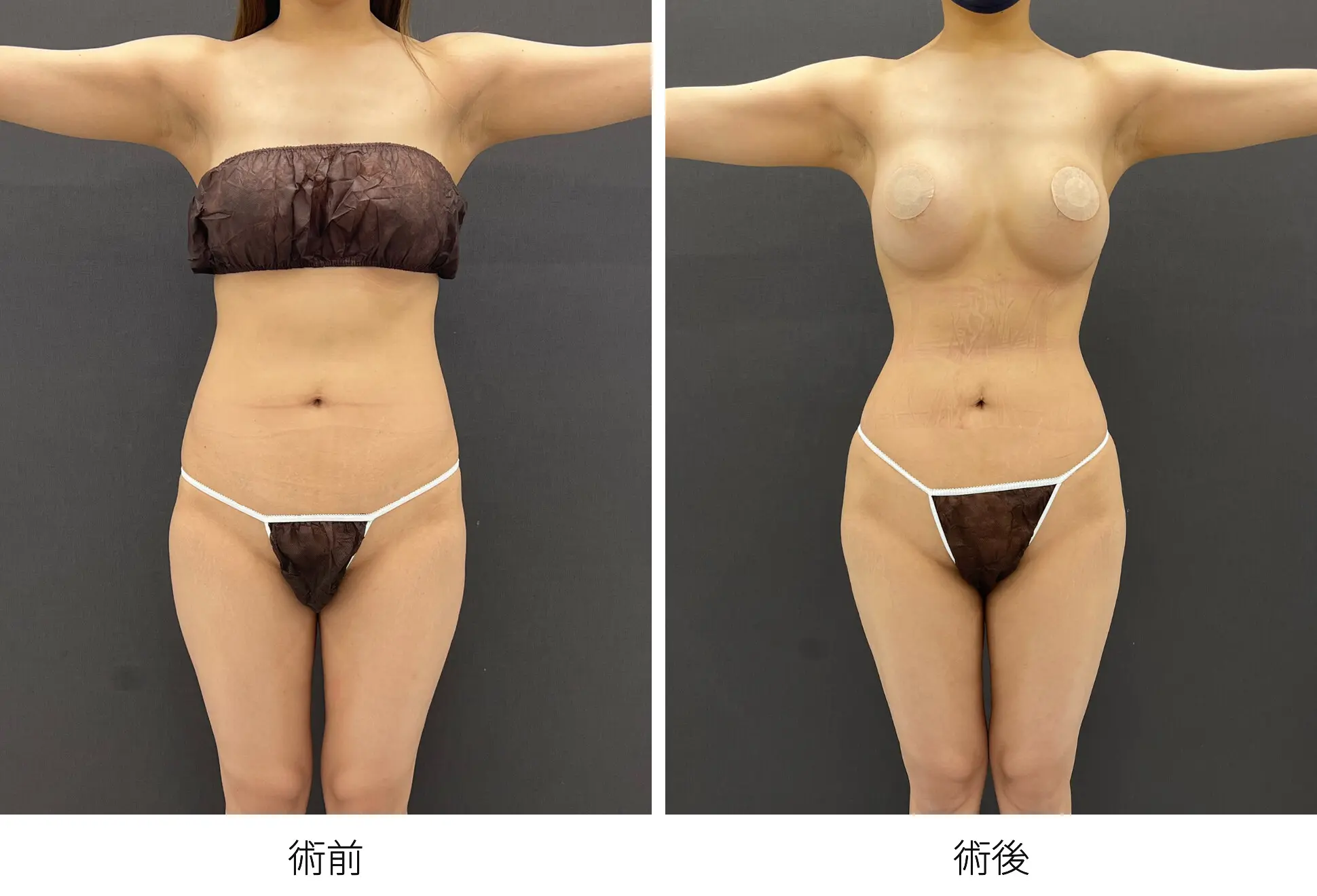 豊尻術・ブラジリアンバットリフト（アジアンバットリフト） | 豊胸