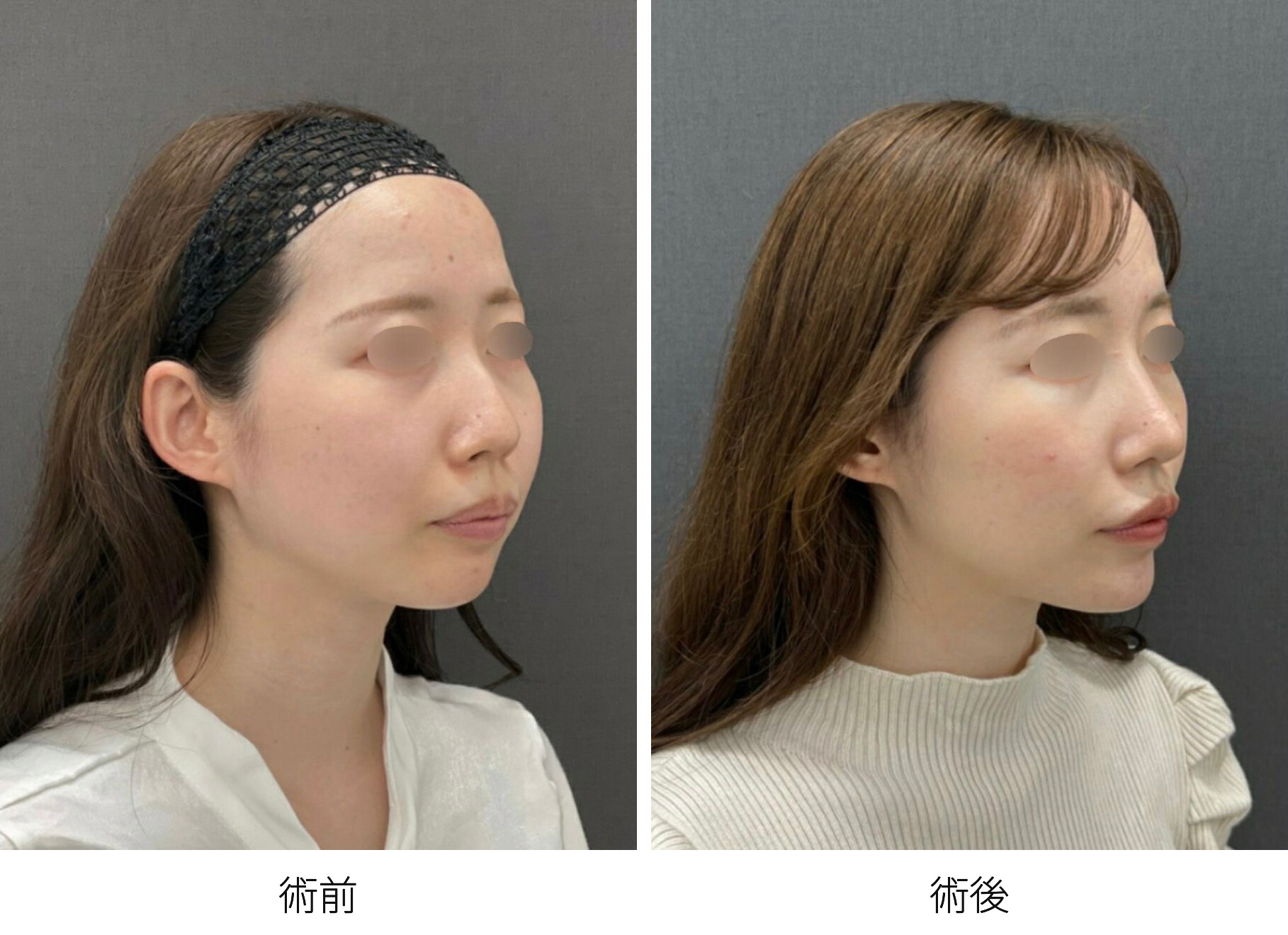 鼻尖形成（ドーマルスーチャー法） 鼻中隔延長術（鼻中隔軟骨・耳介移植）