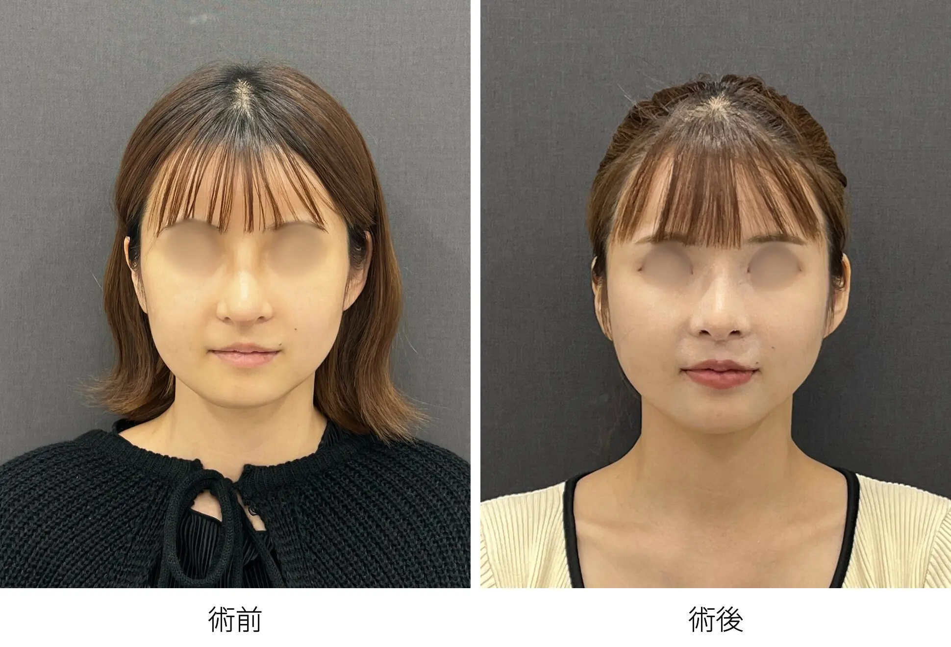 存在感のない鼻をつくる整鼻術｜銀座 美容外科のロシッククリニック銀座