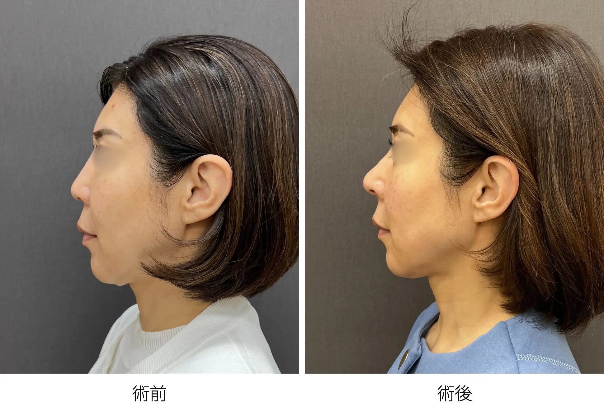 存在感のない鼻をつくる整鼻術｜銀座 美容外科のロシッククリニック銀座