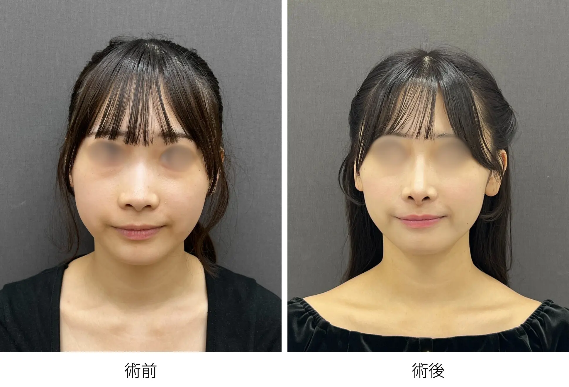 存在感のない鼻をつくる整鼻術｜銀座 美容外科のロシッククリニック銀座