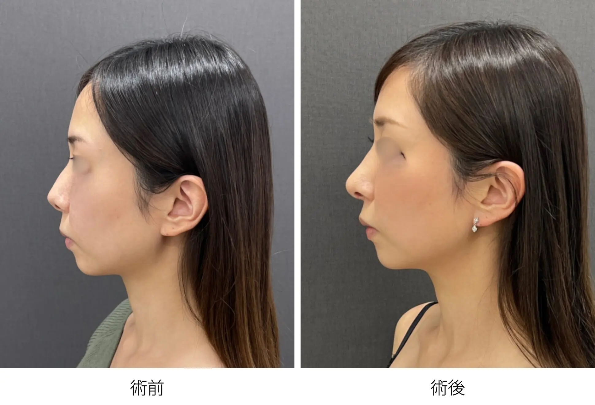 存在感のない鼻をつくる整鼻術｜銀座 美容外科のロシッククリニック銀座