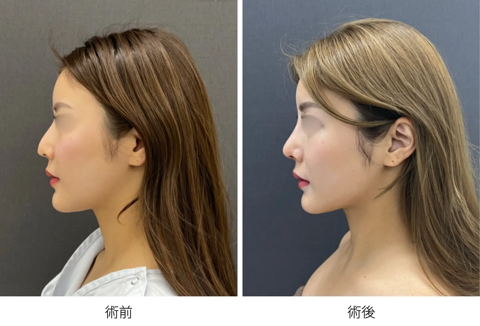 存在感のない鼻をつくる整鼻術｜銀座 美容外科のロシッククリニック銀座