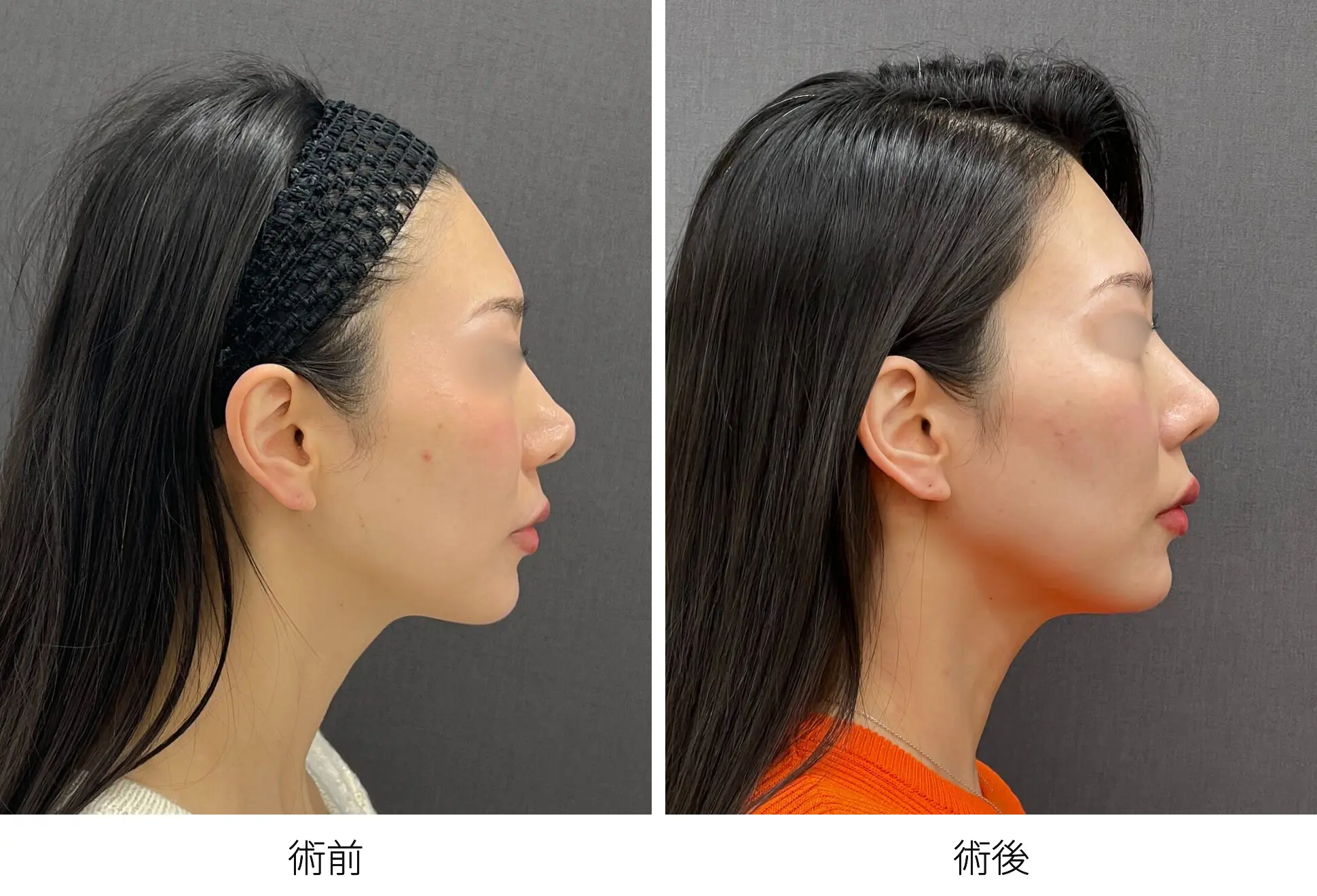 存在感のない鼻をつくる整鼻術｜銀座 美容外科のロシッククリニック銀座