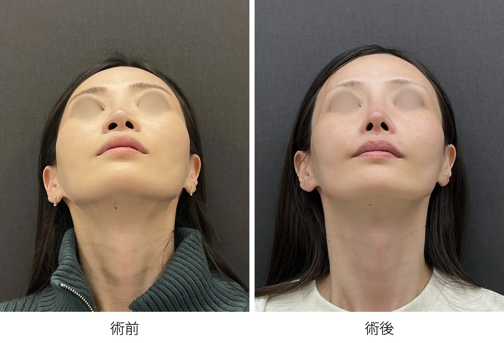 存在感のない鼻をつくる整鼻術｜銀座 美容外科のロシッククリニック銀座