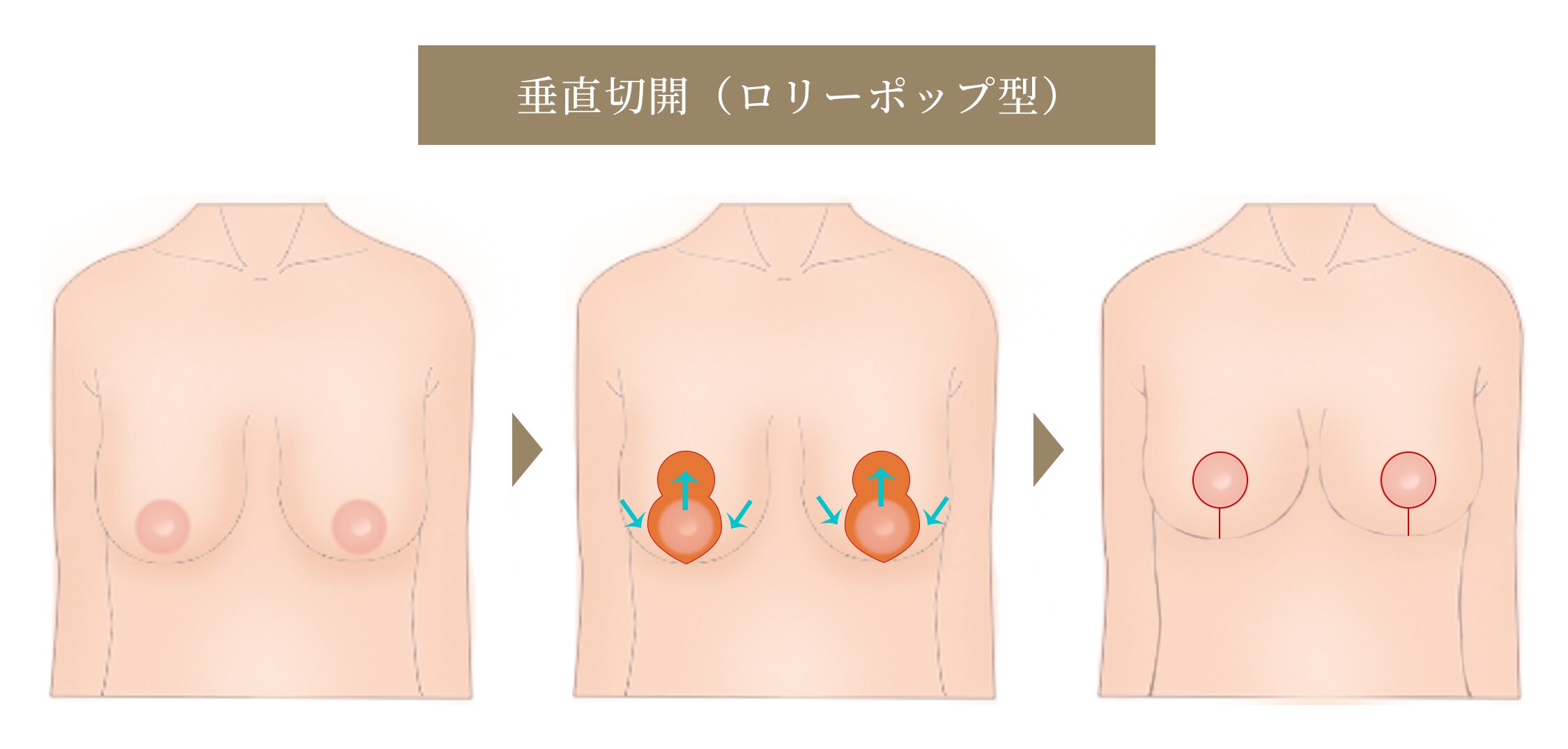 乳房挙上 垂れ乳修正 垂直切開（ロリーポップ型）