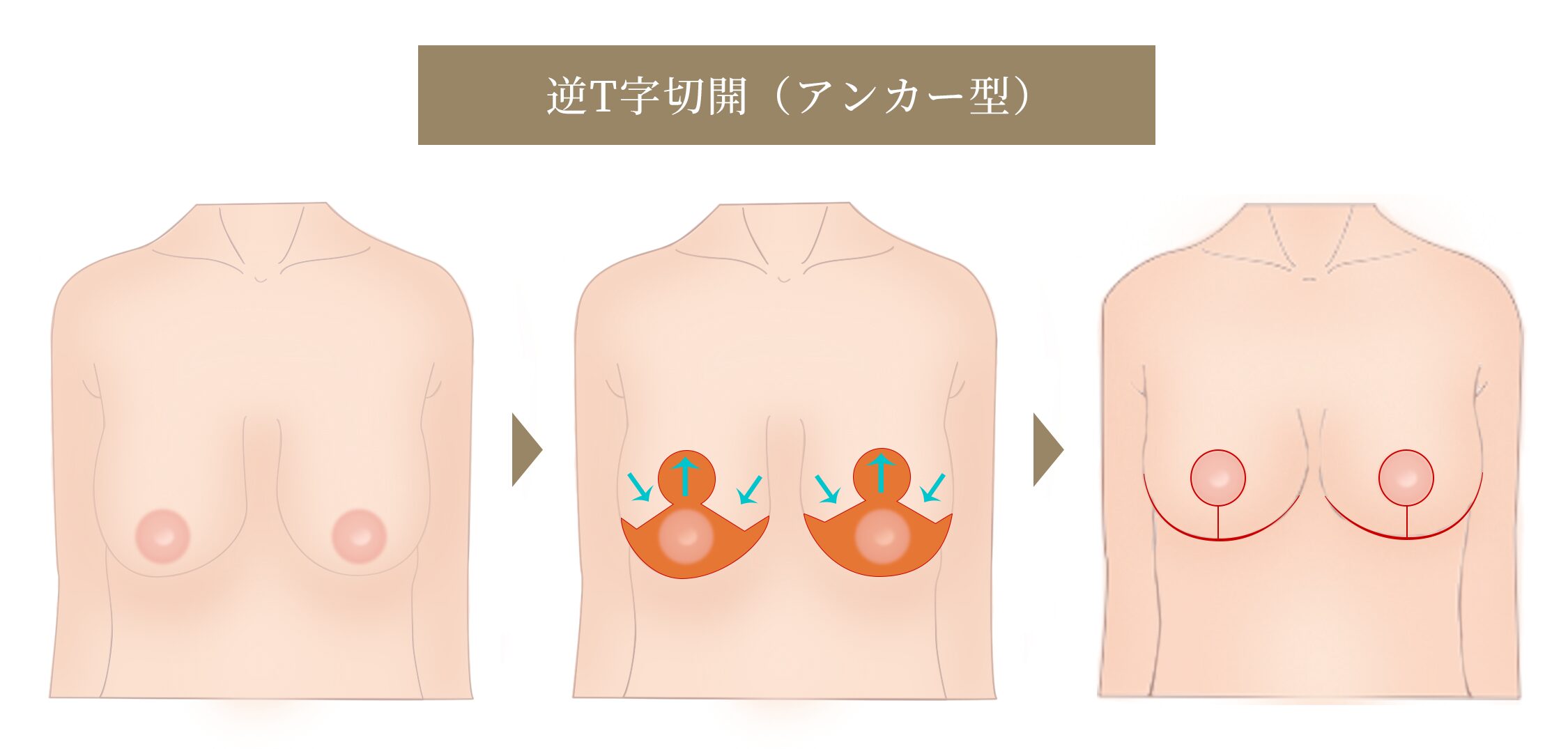 乳房挙上 垂れ乳修正 逆T字切開（アンカー型）